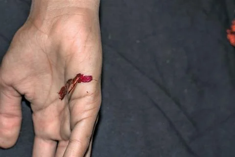 Sharp thorn dipped into a human hand and it's bleeding Stock Photos