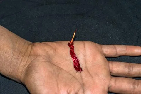 Sharp thorn dipped into a human hand and it's bleeding Foto stock