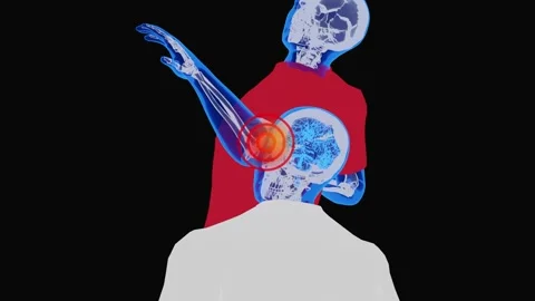 Shin Splints and Lower Leg Sports Injury Medical Visualization Video stock 342089075