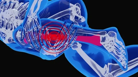 Shin Splints and Lower Leg Sports Injury Medical Visualization Video stock 342089079