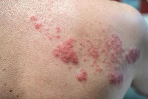 Shingles (Disease), Herpes zoster, varicella-zoster virus. skin rash and blis Stock Photos