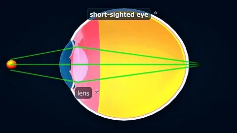 Short sighted eye Stock Footage 320657800