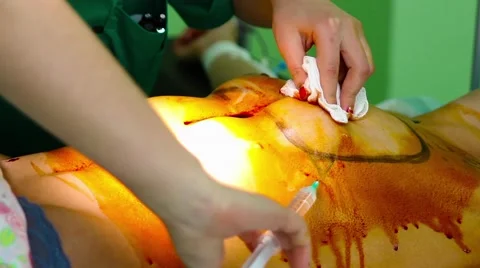 Shot in the chest during a plastic surgery Stock Footage 64015855