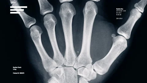 Shot of hand X-Ray being inspected in computer with mouse cursor moving around Stock Footage 219603986