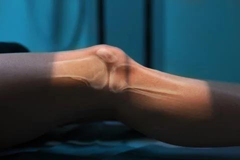 Shot of process x-ray, knee close-up. Drawing bones and kneecap 写真素材