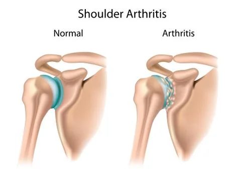 Shoulder arthritis Stock Illustration