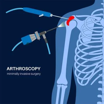 Shoulder arthroscopy poster Stock Illustration