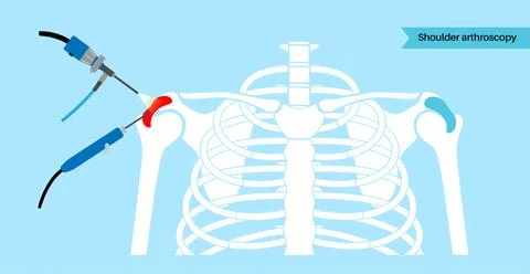 Shoulder arthroscopy poster Stock Illustration