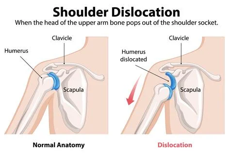 Shoulder Dislocation Anatomy Illustration Stock Illustration