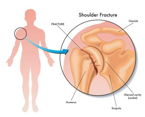Shoulder fracture Stock Illustration