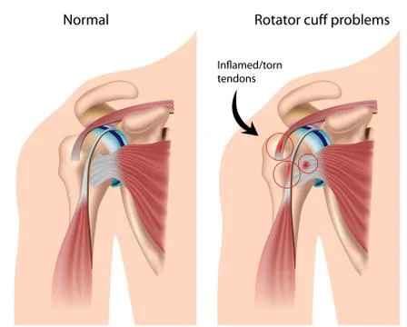 Shoulder Impingement Stock Illustration