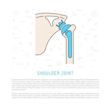 Shoulder joint replacement Stock Illustration
