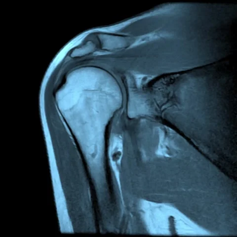 Shoulder MRI movement Stock Footage 260570891