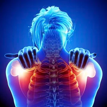 Shoulder pain, artwork Stock Illustration
