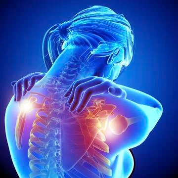 Shoulder pain, artwork Stock Illustration