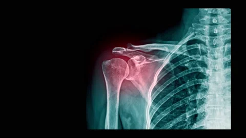 Shoulder pain x-ray Video stock 148598711