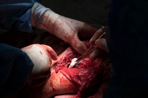 Shoulder surgery Photos