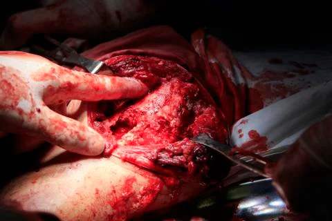 Shoulder surgery 写真素材