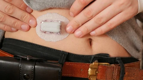 Showing attached dexcom transmitter, real-time glucose reading Stock Footage 102127156