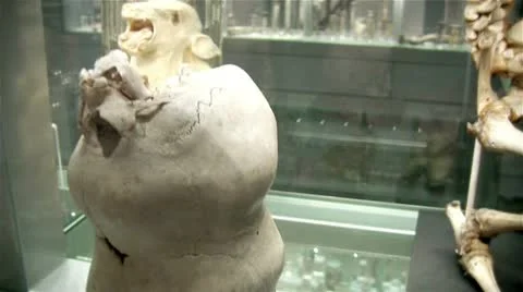 Siamese twins joined skull 2 Video stock 11462878