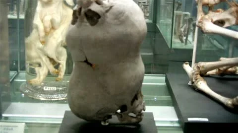 Siamese twins joined skull Video stock 11461758
