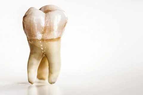 Sick decayed molar tooth Stock Photos