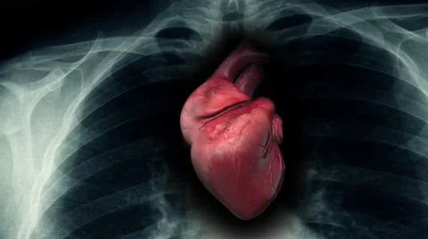 Sick Human Heart Inside Of X-Ray Stock Footage