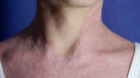 Sick man with psoriasis is scratching his dry itchy skin on neck, close-up view Видео 95164032
