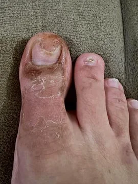 Sick nail Stock Photos