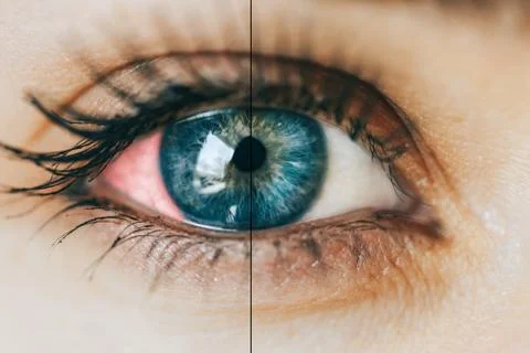 Sick red eye Stock Photos