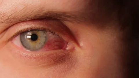 Sick Red Man Eye Stock Footage 73729685