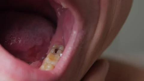 Sick Tooth Closeup Stock Footage 166183034