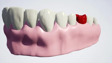 Sick tooth in the jaw on a white background. 3d illustration Stock Footage 129207527