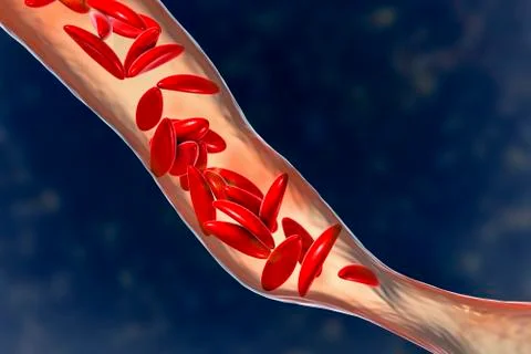 Sickle cell anemia Stock Illustration