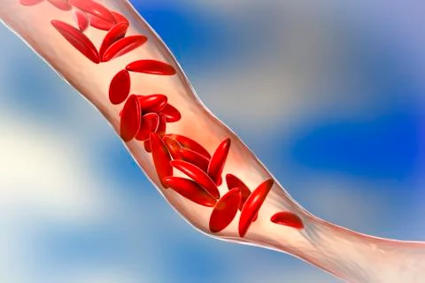 Sickle cell anemia Stock Illustration