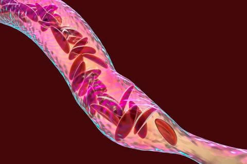 Sickle cell anemia Stock Illustration