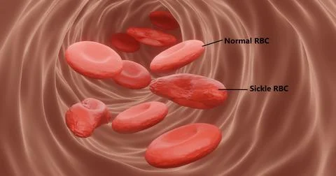 Sickle cell anemia labeled Illustrazione stock