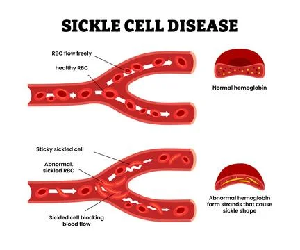 Sickle cell disease with abnormal red blood cells that blocking blood flow... Stock Illustration