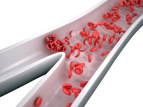 Sickle Cells Blocking Blood Flow - isolated on white 스톡 일러스트