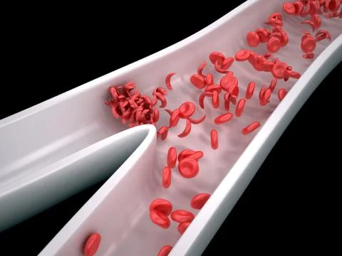 Sickle Cells Blocking Blood Flow Stock-Illustration