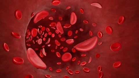 Sickle cells Stock Footage 157447001
