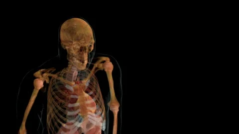 Side Effects of Chemotherapy 動画素材 113234339