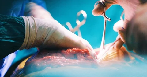 Side &amp; low angle view of surgeons hands operating with scissors on body tissue Stock Footage 126785953