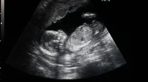 Side profile of a baby moving during a ultrasound Stock Footage