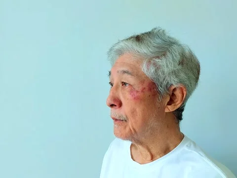 The Side Profile of an Old Asian Man with Visible Skin Rash and Facial Hair Vídeos de archivo 346795581