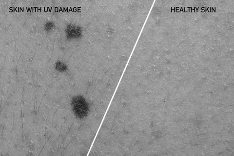 A side by side comparison of human skin with and without UV damage from direc 스톡 사진