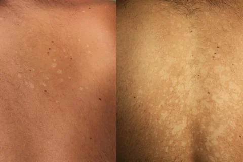 Side-by-side comparison showing the progression of untreated tinea versicolor Stock Photos