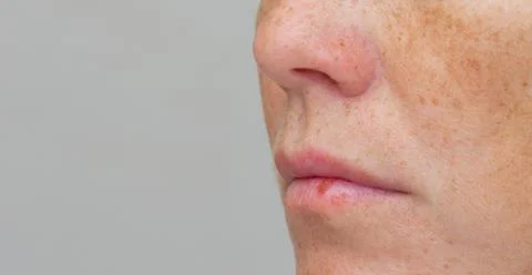 Side view of cropped face with herpes on lower lip Stock Photos