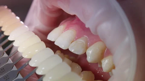 Side View of Dental Shade Guide in Use for Cosmetic Dentistry 動画素材 296719679