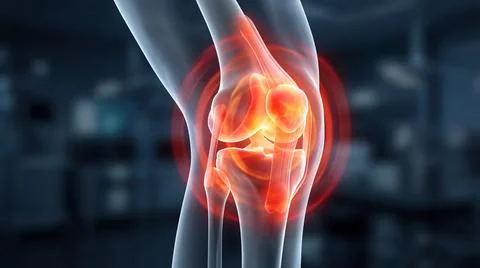 Side view of knee joint showing severe inflammation and orthopedic bone traum Stock Illustration